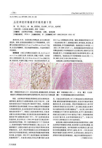 叢狀神經(jīng)纖維瘤并纖維肉瘤1例